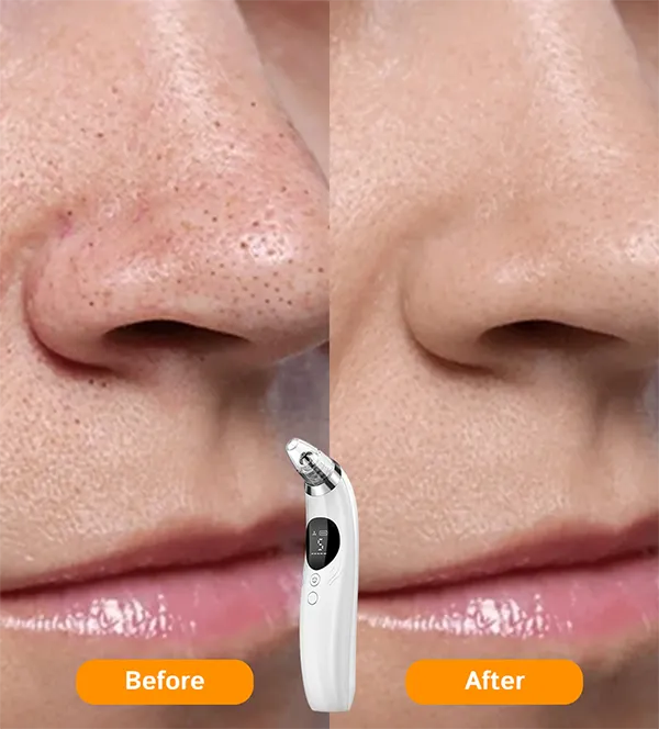 BlaRevia Blackhead Removers