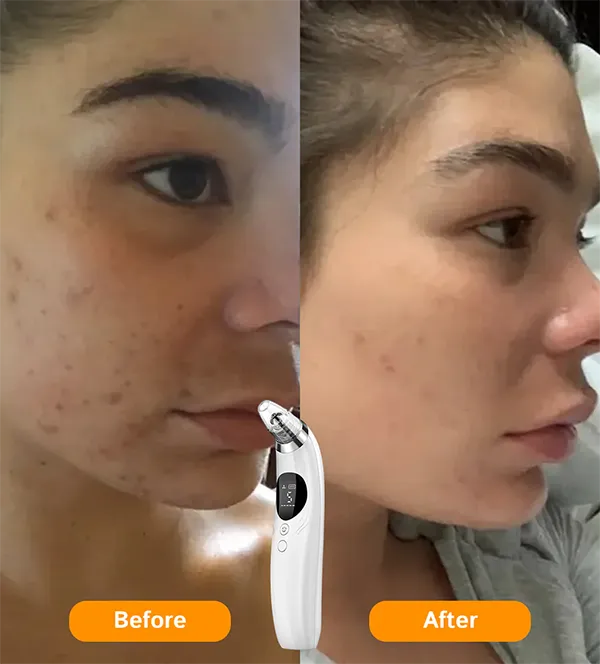 BlaRevia Blackhead Removers