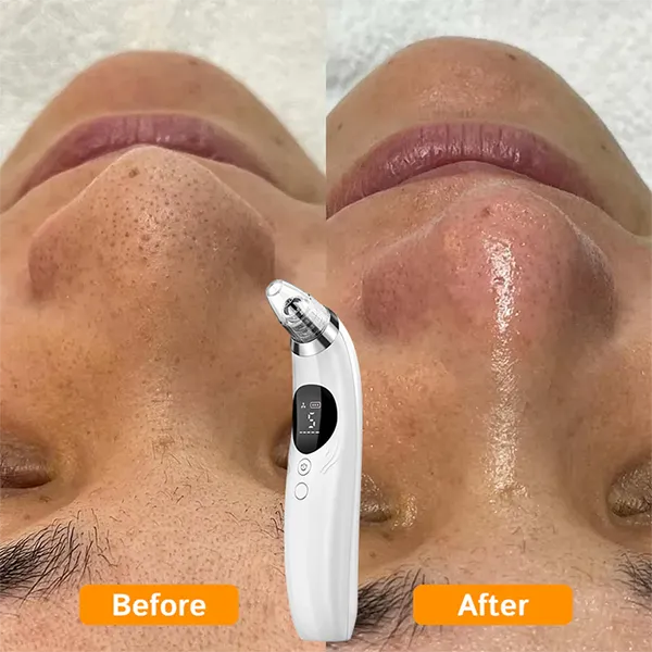 BlaRevia Blackhead Removers