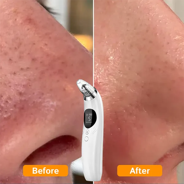 BlaRevia Blackhead Removers